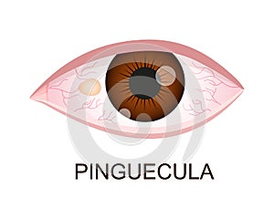 Pinguecula. Conjunctival degeneration. Eye disease. Human organ of vision with pathology. Vector realistic illustration photo