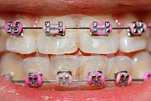 Pink braces