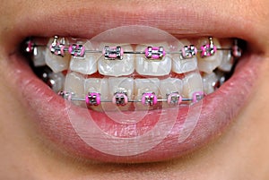 Pink braces