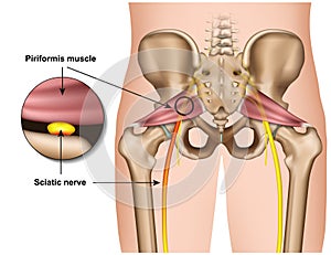 Piriformis syndrome 3d medical  illustration on white background