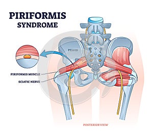 Piriformis syndrome and sciatic nerve compression pain outline diagram