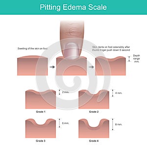 Pitting Edema Scale.