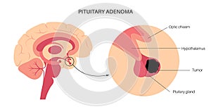 Pituitary adenoma cancer