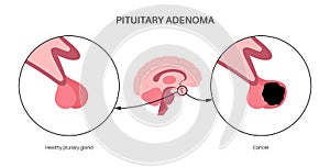 Pituitary adenoma cancer photo