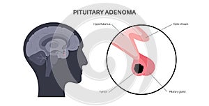 Pituitary adenoma cancer photo