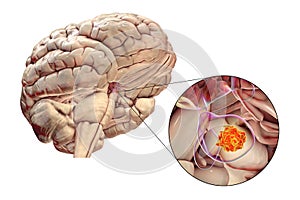 A pituitary gland tumor, 3D illustration