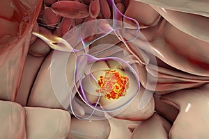 A pituitary gland tumor, 3D illustration