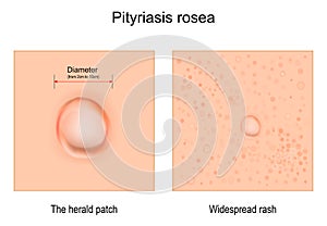 Pityriasis rosea. skin rash