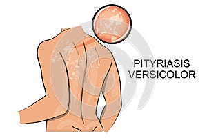 Pityriasis versicolor. dermatology.