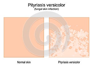 Pityriasis versicolor. fungal skin infection. tinea versicolor photo