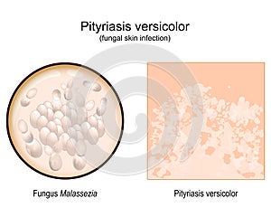 Pityriasis versicolor. skin surface. Malassezia fungi