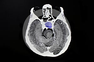 Piuitary tumor