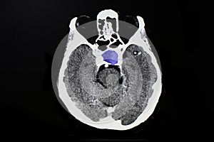 Piuitary tumor photo