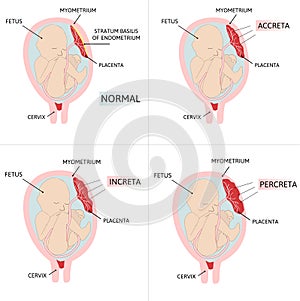 Placenta accreta. Accrete, increta, percreta. colored medical