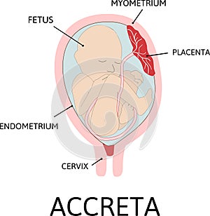 Placenta accreta. grades of abnormal attachment illustrated according to the depth photo