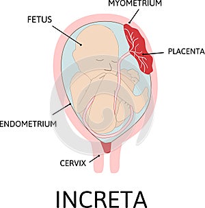 Placenta increta. grades of abnormal attachment illustrated according to the depth photo