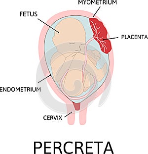 Placenta accreta. grades of abnormal attachment illustrated according to the depth photo