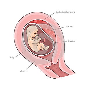 Placental abruption structure medical science