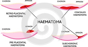 Placental haematoma. blood clots that arise from the placenta. Depending on their location it is retro-placental, subchorionic or