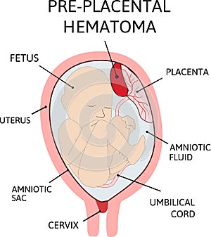 Placental hematoma. blood clots that arise from the placenta