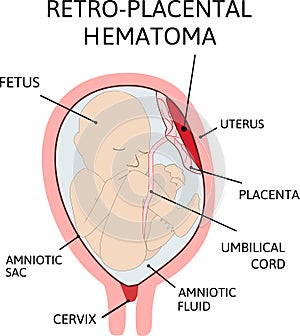 Placental hematoma. blood clots that arise from the placenta
