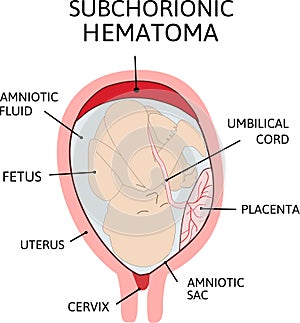 Placental hematoma. blood clots that arise from the placenta