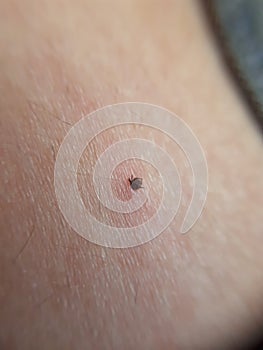 Plague ticks. Lyme disease
