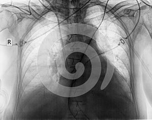 Plain chest radiograph of patient after surgery photo