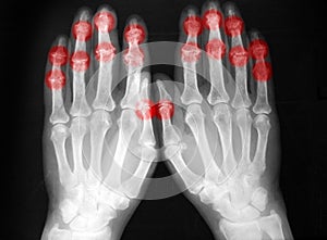Plain film, radiography, of both hands, arthritis photo