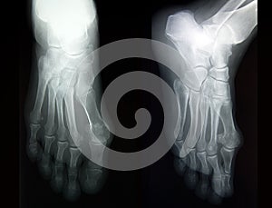 Plain film X-ray, radiography, of complete foot in two projections