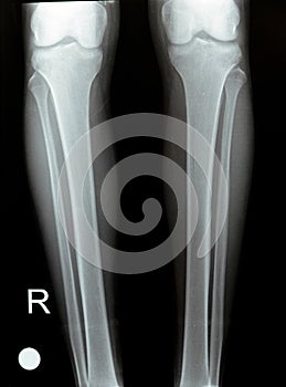 Plain X ray of both right and left knee joints with lower part of femur and upper parts of tibia and fibula and patella showing