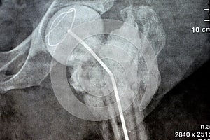 Plain X ray hip joint show left trans cervical fracture of the head of femur with temporary antibiotic loader spacer antibiotic-