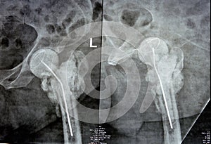 Plain X ray hip joint show left trans cervical fracture of the head of femur with temporary antibiotic loader spacer antibiotic-