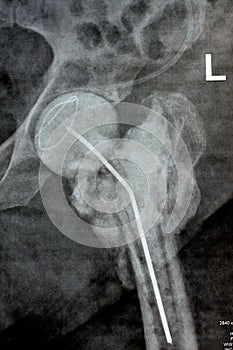 Plain X ray hip joint show left trans cervical fracture of the head of femur with temporary antibiotic loader spacer antibiotic-