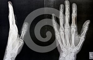 Plain x ray of the left hand of an adult male after a direct trauma to the left thumb finger showing normal bone study, normal x