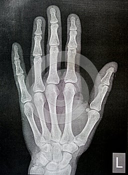 Plain x ray of the left hand of an adult male after a direct trauma to the left thumb finger showing normal bone study, normal x