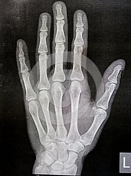 Plain x ray of the left hand of an adult male after a direct trauma to the left thumb finger showing normal bone study, normal x