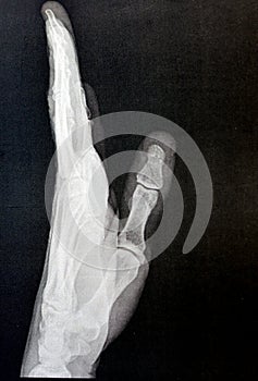 Plain x ray of the left hand of an adult male after a direct trauma to the left thumb finger showing normal bone study, normal x