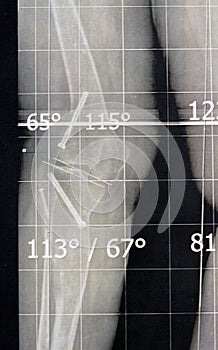 Plain x ray long film standing position showing both legs with bilateral metaphyseal genu varum, previous epiphysiodesis, left