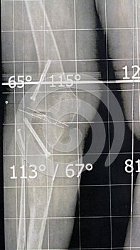 Plain x ray long film standing position showing both legs with bilateral metaphyseal genu varum, previous epiphysiodesis, left