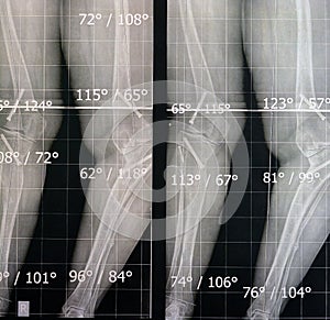 Plain x ray long film standing position showing both legs with bilateral metaphyseal genu varum, previous epiphysiodesis, left