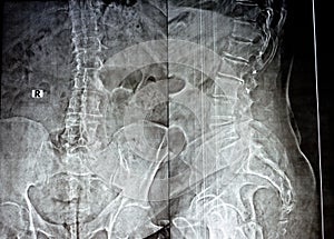 Plain x ray of the lumber spine in AP and lateral views, marginal anterior osteophytic lipping of the vertebral end plates,