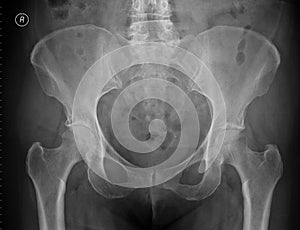 Plain x-ray of the pelvis
