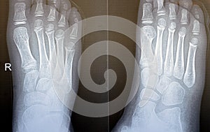 Plain x ray of the right foot of a 9 years old child shows normal pediatric bone xray study, with ossification centers of a normal
