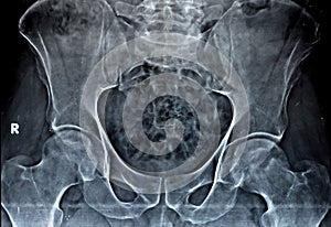 Plain X-ray of both hip joints revealed slight narrowing of superolateral aspect of both hip joints spaces with subchondral photo