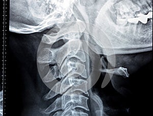 Plain X ray of cervical spine revealed straightened cervical curve, spondylosis osteophytic lipping of C3, C4, C5 vertebral end photo