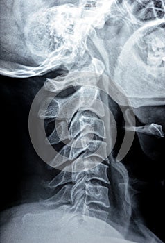 Plain X ray of cervical spine revealed straightened cervical curve, spondylosis osteophytic lipping of C3, C4, C5 vertebral end photo