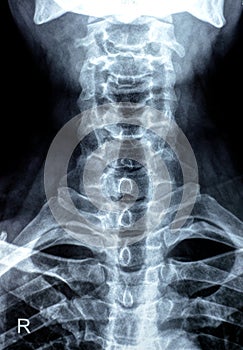 Plain X ray of cervical spine revealed straightened cervical curve, spondylosis osteophytic lipping of C3, C4, C5 vertebral end photo