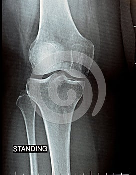 plain x ray on knee joint showing joint space narrowing and Subchondral Sclerosis on medial compartment photo