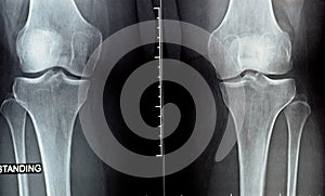 plain x ray on knee joint showing joint space narrowing and Subchondral Sclerosis on medial compartment